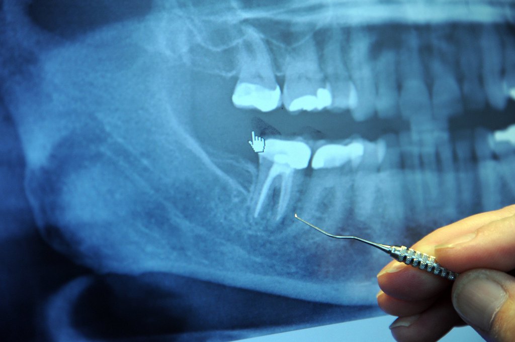 Crucial Facts of Tooth Abscesses