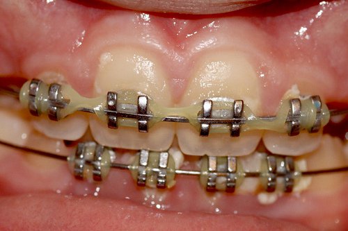 10 Important Things to Know Before You Get Dental Braces